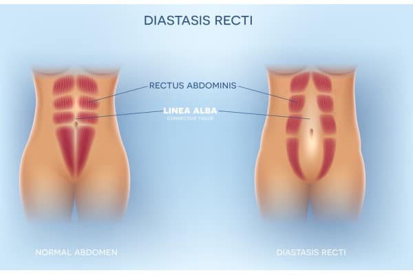 What Non-Surgical Options Are Available for Diastasis Recti Bromyard?