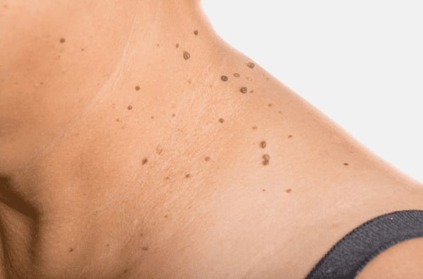 Are you looking for easy skin tag removal Bromyard - then contact Spire today!