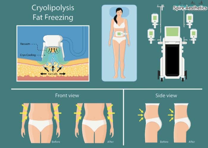 Image of diet and fat freezing combined for best results for Spire Aesthetics Bromyard