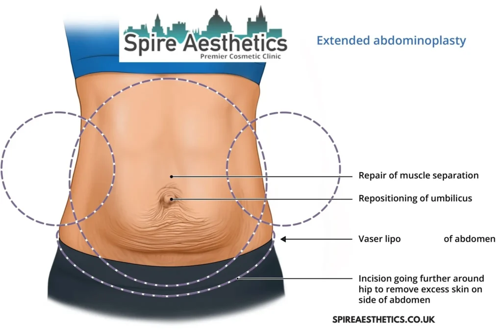 Understanding Loose Skin After Gastric Band Bromyard Surgery and HIFU Treatment