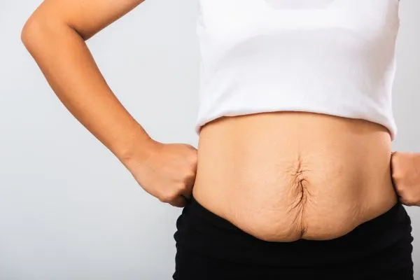 Image of a woman's stomach after weight loss with sagging skin following a gastric band Bromyard