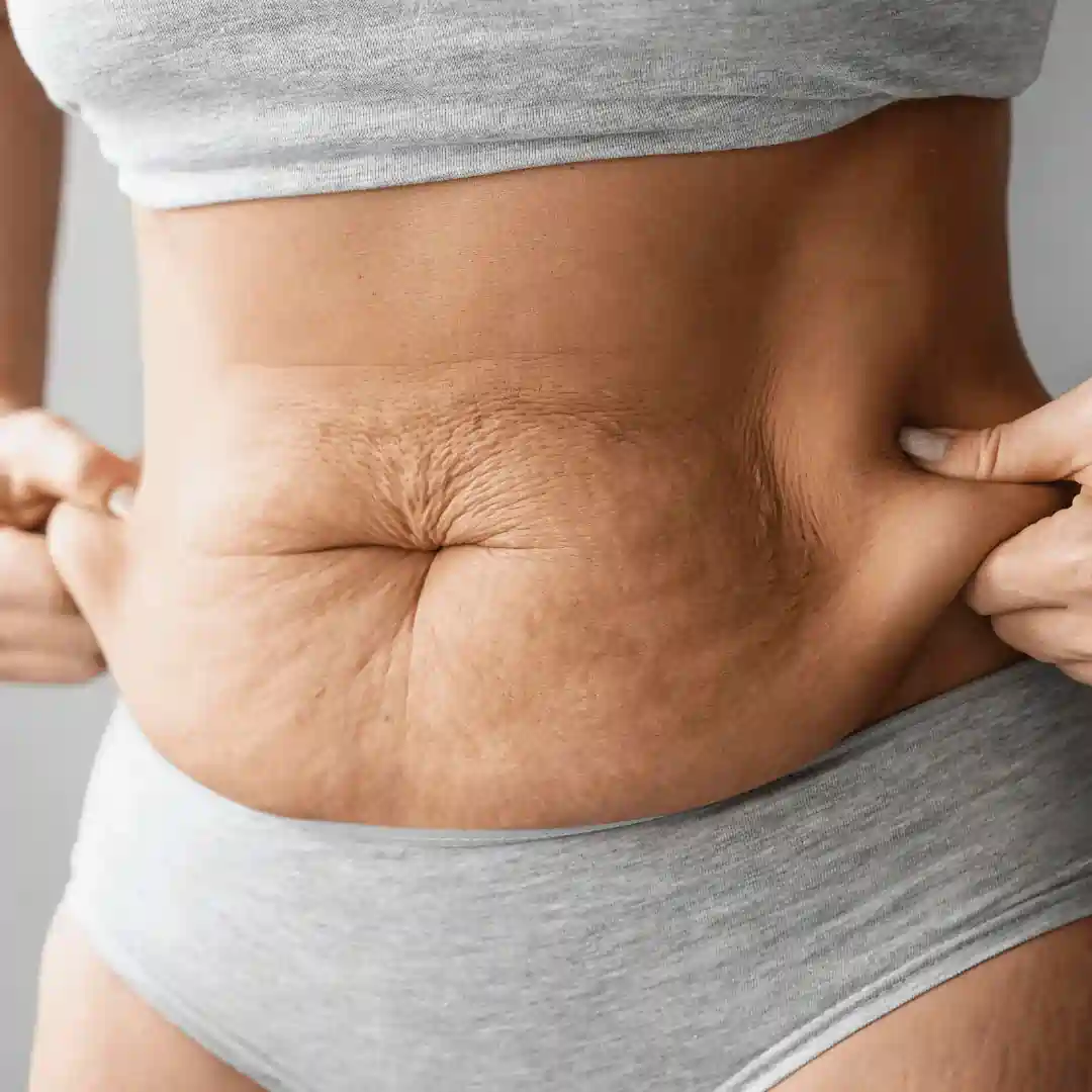 Is It Normal to Have Loose Skin After Pregnancy Bromyard?